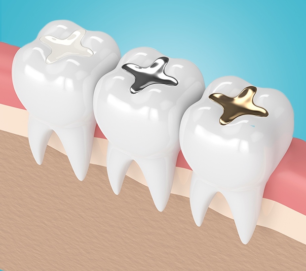 Clearwater Composite Fillings