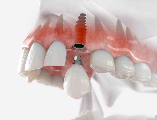 Dental Implant Clearwater, FL