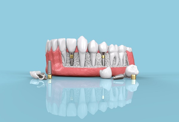 Can You Get Dental Implants For More Than One Missing Tooth?
