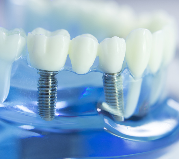 Clearwater Dental Implants